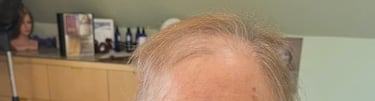 Before permanent non-surgical hair replacement #16 – noticeable patch of thinning near the crown – w