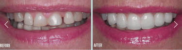 Cosmedic Express clinics in Turkey/Albania perform Dental Implants and Cosmetic Dentistry