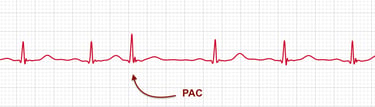 Apple Watch ECG strip showing a Premature Atrial Contraction (PAC) identified with a red arrow.