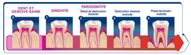 Les stades d’évolution de la parodontite source UFSBD hygiene-precision.com