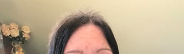 Before permanent non-surgical hair replacement #9 – thinning on top and crown with visible scalp – w
