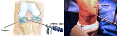 arthroscopy surgery, key hole surgery
