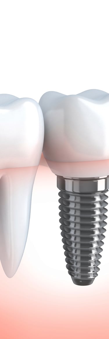 Dantų implantacija Palangoje