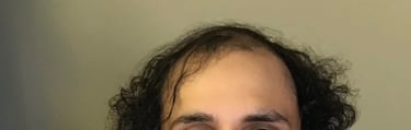 Before permanent non-surgical hair replacement #23 – thinning on top and receding hairline – man in 