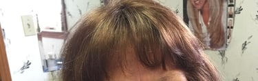 Before permanent non-surgical hair replacement #1 – diffuse thinning on top and part line – woman in