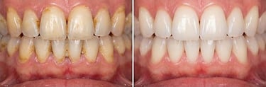 Dental aeropolishing before and after hygiene-precision.com