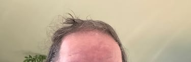  Before permanent non-surgical hair replacement #24 – advanced thinning at crown and top of scalp – 