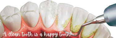Teeth Cleaning