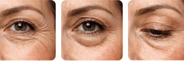 Ojos de mujer que necesitan blefaroplastia