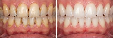 Dental aeropolishing before and after hygiene-precision.com
