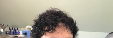 After permanent non-surgical hair replacement #23 with strand by strand method – fuller top and more