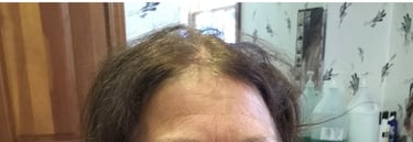 Before permanent non-surgical hair replacement #1 – diffuse thinning on top and part line – woman in