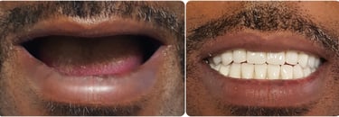 All on four dientes de porcelana