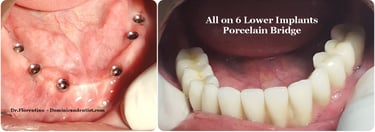 One arch dental implants Santiago Dominican Republic