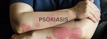 psoriasis treatment in chennai