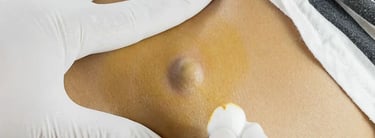 ​Sebaceous Cyst Removal ray and rio's speciality clinic