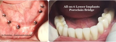 Puente de porcelana fijo sobre implantes