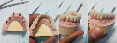 Puente porcelana sobre implantes