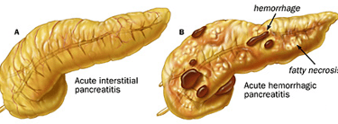 GASTRO FOUNDATION acute pancreatitis