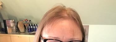 Before permanent non-surgical hair replacement #9 – thinning on top and crown with visible scalp – w