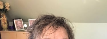 Before permanent non-surgical hair replacement #6 – patchy thinning areas across the scalp – woman i