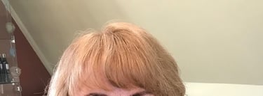 After permanent non-surgical hair replacement #5 with Micropoint Helix solution – fuller top and sid