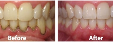 scaling and polishing in baner
