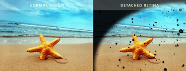 Normal eye vs eye with retinal detachment explaining about how vision with RD look like.