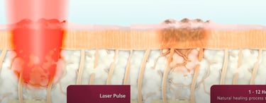 digital peel laser