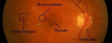 Best Experienced Retina Uvea Glaucoma Specialist Faridabad Fundus SD OCT VFA Perimetry Visual Field