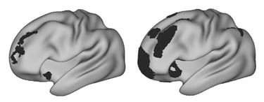 Brain MRI shows differences in the brain of a person with depression.
