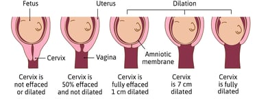 a diagram of how the cervical tissue thins and the cervical opening widens during labor