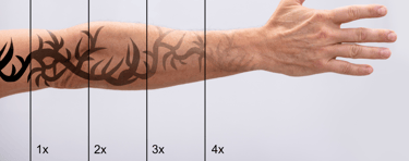 a mans arm showing the progression of laser tattoo removal