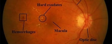 Best Experienced Retina Uvea Glaucoma Specialist Faridabad Fundus SD OCT VFA Perimetry Visual Field