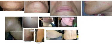 skin-after-electrology-treatment