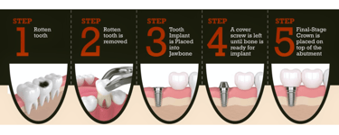 Dental Implant Procedure | Ekdantam dental clinic