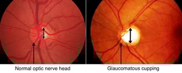 image of normal optic nerve head in healthy people vs glaucomatous cupping in eye with glaucoma