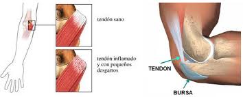 Tendinitis y bursitis