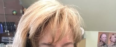 After permanent non-surgical hair replacement #11 with Micropoint Helix solution – added coverage an