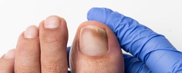 Tratamento de Micose nas Unhas em Joinville | Essence Podologia e Bem Estar