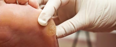 Tratamento de Calos e Fissuras nos pés em Joinville | Essence Podologia e Bem Estar