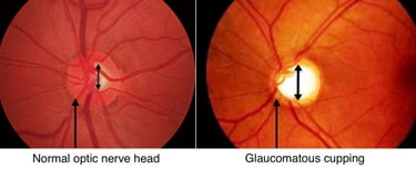 image of normal optic nerve head in healthy people vs glaucomatous cupping in eye with glaucoma