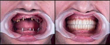 Affordable dental implants near me, Dental implants in nerul , Dental implants in sanpada, 