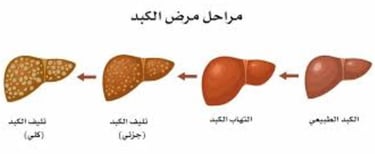 _احذروا المصير المحتوم للكبد الدهني وتشمع الكبد وتليف الكبد ودوالي المريء وسرطان الكبد (2)
