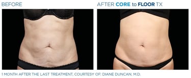 Before and after photos of a person&amp;amp;#x27;s torso standing up showing more body sculpting