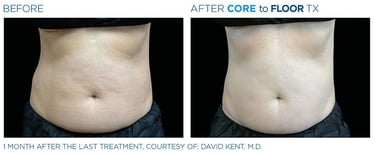 Before and after photos of a person&amp;amp;#x27;s torso standing up showing more body sculpting