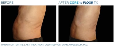 Before and after photos of a person&amp;amp;#x27;s torso standing up showing more body sculpting