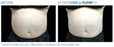 before and after pictures of a mans abdomen showing emsculpt neo treatment