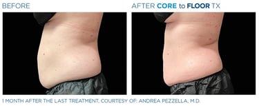 before and after pictures of a mans side-view showing emsculpt neo treatment