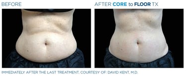 before and after pictures of a womans abdomen showing emsculpt neo treatment